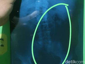 Warga Batang Syok Divonis HIV Usai Operasi Kencing Batu, Ternyata... Warga Batang Syok Divonis HIV Usai Operasi Kencing Batu, Ternyata...