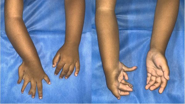 Foto Anak 2 Tahun Terlahir dengan Kondisi Langka, Punya Banyak Jari dan Tulang Lengan