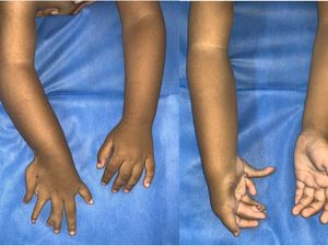 Foto Anak 2 Tahun Terlahir dengan Kondisi Langka, Punya Banyak Jari dan Tulang Lengan Foto Anak 2 Tahun Terlahir dengan Kondisi Langka, Punya Banyak Jari dan Tulang Lengan