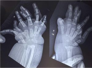 Bayi di India Lahir dengan Banyak Jari Tangan, Ini Penampakannya Bayi di India Lahir dengan Banyak Jari Tangan, Ini Penampakannya