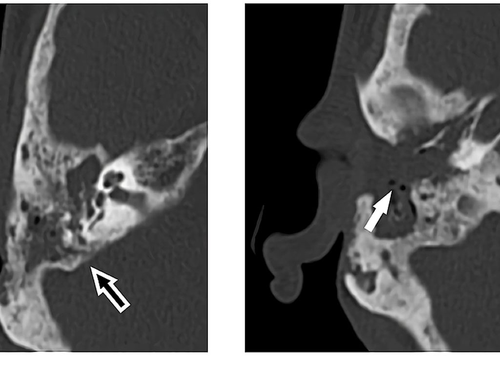 Merinding! Dokter Temukan Banyak Belatung Bersarang di Telinga Pria Ini Merinding! Dokter Temukan Banyak Belatung Bersarang di Telinga Pria Ini