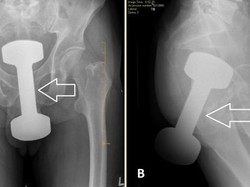 Nggak Habis Pikir, Dokter Keluarkan Dumbell Gym 2 Kg dari Anus Pasien