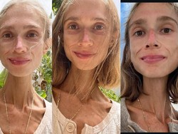 Kondisi Wanita Polandia Sebelum Mati Kelaparan di Bali gegara Diet Buah Ekstrem