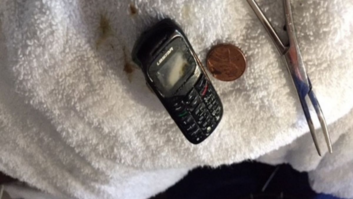 Momen Dokter Keluarkan Ponsel dari Lambung Pasien, Begini Penampakannya