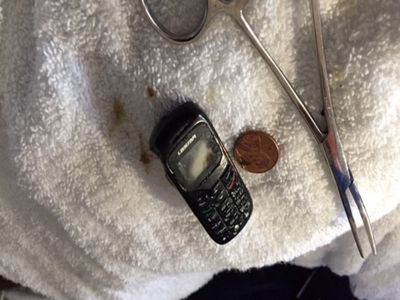 Foto: Dokter Angkat HP yang Nyangkut di Perut Pasien, Penampakannya Bikin Ngilu