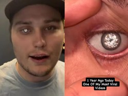 Cerita di Balik Viral Pria Punya Mata Palsu Berhiaskan Berlian Mewah