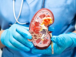 Begini Perubahan Warna Urine yang Menandakan Gagal Ginjal