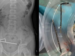 Ngilu! Momen Dokter Keluarkan 100 Magnet dari Usus Remaja 13 Tahun Ngilu! Momen Dokter Keluarkan 100 Magnet dari Usus Remaja 13 Tahun