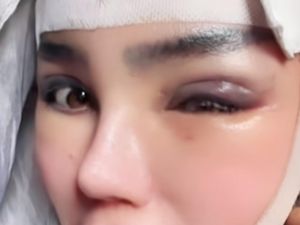 Viral Demi Wajah Runcing Permanen, PNS Lampung Yuni Jasmine Jalani Operasi