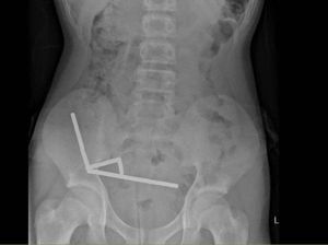 Seorang Remaja Telan Hampir 200 Magnet, Sebagian Usus Hilang Seorang Remaja Telan Hampir 200 Magnet, Sebagian Usus Hilang
