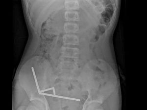 Penampakan Ngeri Usus Anak 13 Tahun usai Telan 100 Magnet, Berakhir Dioperasi