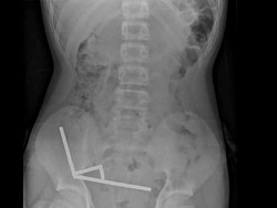 Penampakan Ngeri Usus Anak 13 Tahun usai Telan 100 Magnet, Berakhir Dioperasi Penampakan Ngeri Usus Anak 13 Tahun usai Telan 100 Magnet, Berakhir Dioperasi