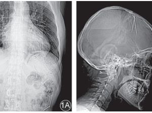 Foto Rontgen Ini Ungkap Temuan Jarum Misterius di Tubuh Pasien, Masuk Lewat Mana?