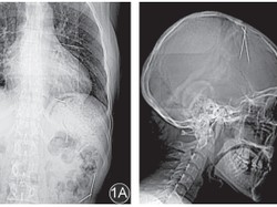 Foto Rontgen Ini Ungkap Temuan Jarum Misterius di Tubuh Pasien, Masuk Lewat Mana?
