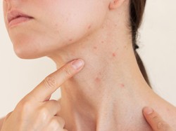 Kenapa Jerawat Muncul di Leher? Ini Penyebab dan Cara Menghilangkannya