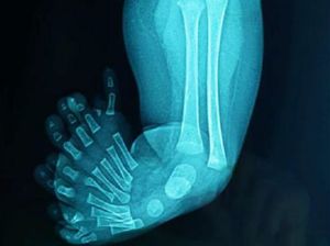 Bayi di Aceh Punya 10 Jari Kaki, Begini Penampakannya