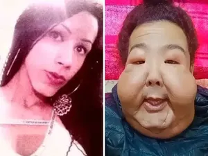 Influencer Disuntik Filler Isi Minyak-Pencahar, Wajahnya Jadi Begini