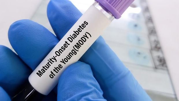 Blood sample for MODY or Maturity-Onset Diabetes of the Young test to diagnose neonatal diabetes (ND) in a symptomatic individual.