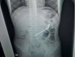 Ngilu! Bocah Ini Tak Sengaja Telan Sendok, Baru Dikeluarkan 10 Hari Kemudian