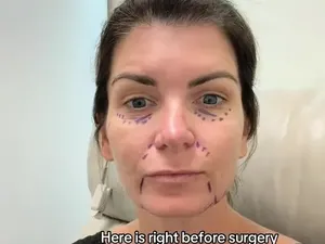 Habiskan Rp 1,2 M untuk Facelift, Wanita Ini Kena Mental Lihat Hasilnya