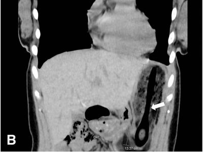 Penampakan Isi Perut Wanita yang Tak Sengaja Telan Sendok Kayu Es Krim