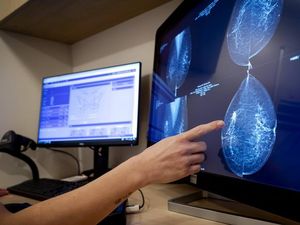 Model AI Baru Prediksi Risiko Kanker Payudara hingga 5 Tahun ke Depan