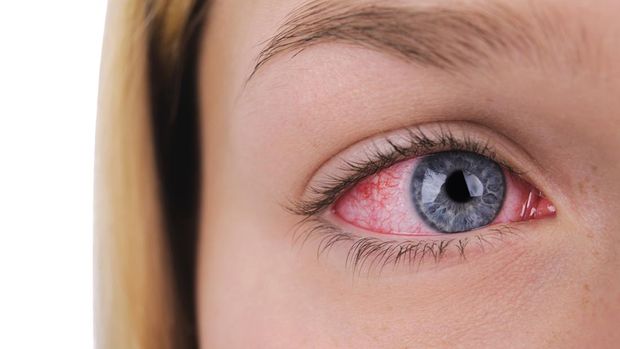 Close up of a red sore eye on a white background.
