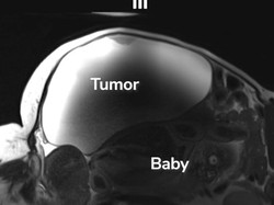 Langka! Ibu Ini Lahirkan Bayi dari Kehamilan di Luar Rahim dengan Kista Hampir 10 Kg