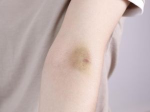 Sering Memar Tanpa Sebab? Ini 10 Penyebabnya Menurut Ahli Kesehatan