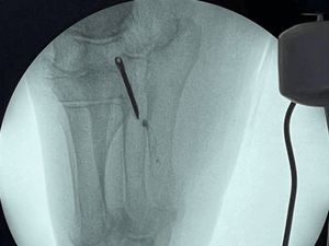 Ngilu! Besi 6,5 Cm Nancap di Kaki Nenek Selama Puluhan Tahun