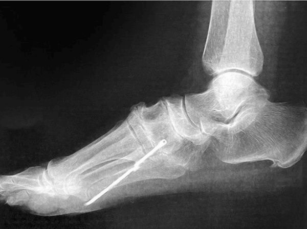 Penampakan Batang Besi Nancap di Kaki Pasien, Baru Ketahuan Setelah 40 Tahun