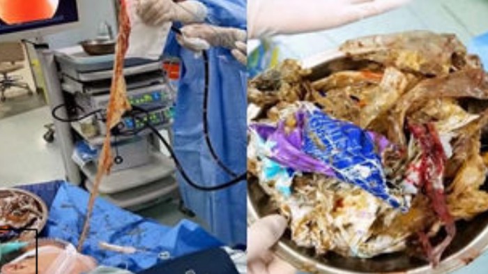 penampakan benda asing plastik 1 kg dalam tubuh pasien