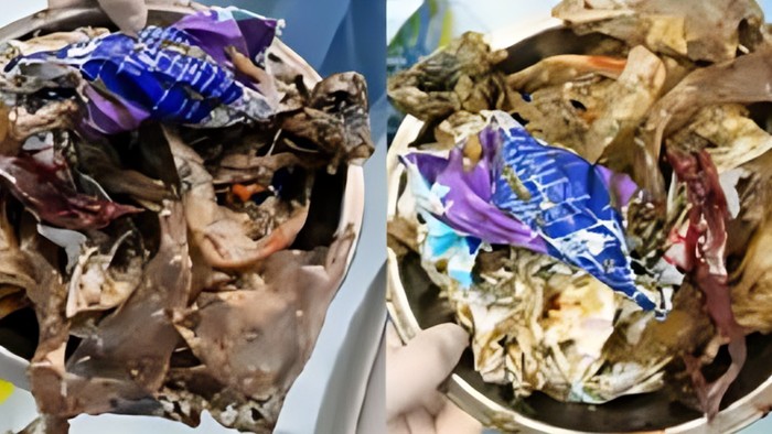 Penampakan plastik 1 kg dalam tubuh pasien.