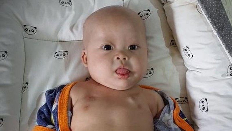 Kisah Chiara Bayi Penderita Tumor Teratoma Immature, Berjuang Ingin Sembuh