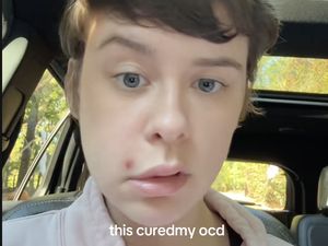 Cerita Wanita yang Kapok Pencet Jerawat, Wajahnya Tiba-tiba Lumpuh