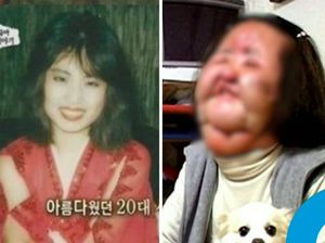 Kisah Tragis Aktris Korea yang Wajahnya Rusak Usai Suntik Minyak Goreng
