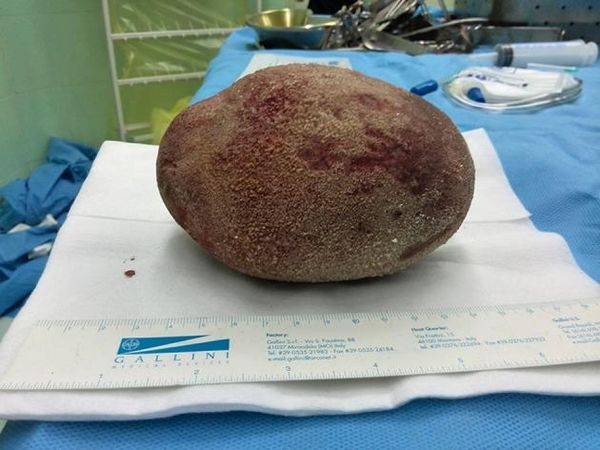 Penampakan Batu Kandung Kemih Bak Telur Raksasa, Beratnya Hampir 1 Kg
