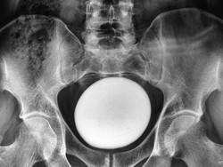 Dokter Temukan Batu Kemih Raksasa di Tubuh Pasien, Ukurannya Mirip Telur Burung Unta