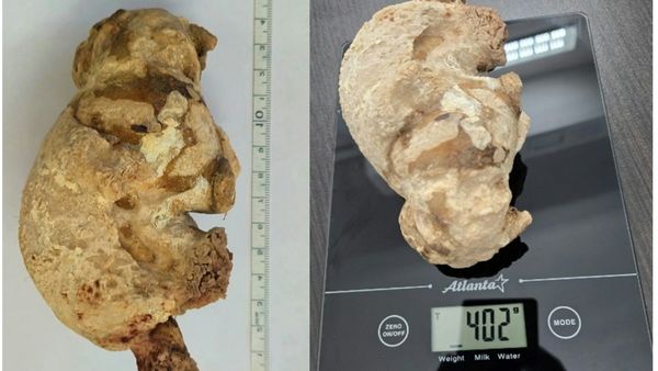 Momen Dokter Temukan Batu Ginjal Raksasa, Diangkat dari Perut Wanita Usia 55