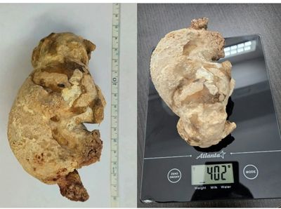 Momen Dokter Temukan Batu Ginjal Raksasa, Diangkat dari Perut Wanita Usia 55