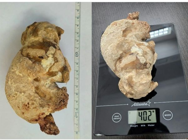 Momen Dokter Temukan Batu Ginjal Raksasa, Diangkat dari Perut Wanita Usia 55