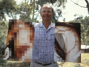 Nelayan Digigit Hiu, Terkoyak Sampai Dapat 462 Jahitan