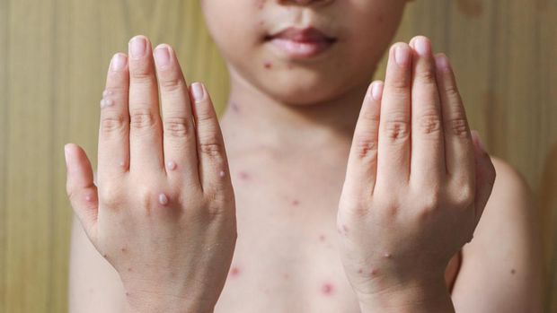 Dokter Ungkap Cacar Air Bisa Menular ke 12 Anak, Hati-hati di Sekolah!