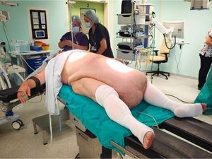 Perut Pria Ini Membesar Tak Wajar, Ternyata Ada Tumor Sebesar 32 Kg