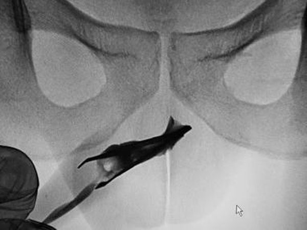 Ngilu! Momen Dokter Temukan Pinset Nyangkut di Mr P Selama 4 Tahun