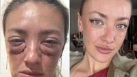 Sempat Syok Usai Operasi di Bawah Mata, Wanita Ini Dicap Oplasnya Gagal