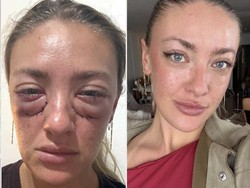 Sempat Syok Usai Operasi di Bawah Mata, Wanita Ini Dicap Oplasnya Gagal