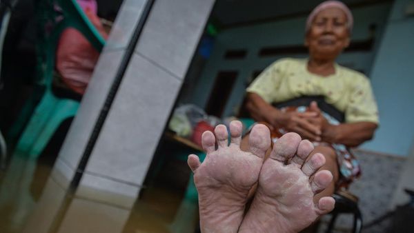Banjir Belum Surut di Desa Pasir Ampo, Warga Mengeluh Penyakit Kulit