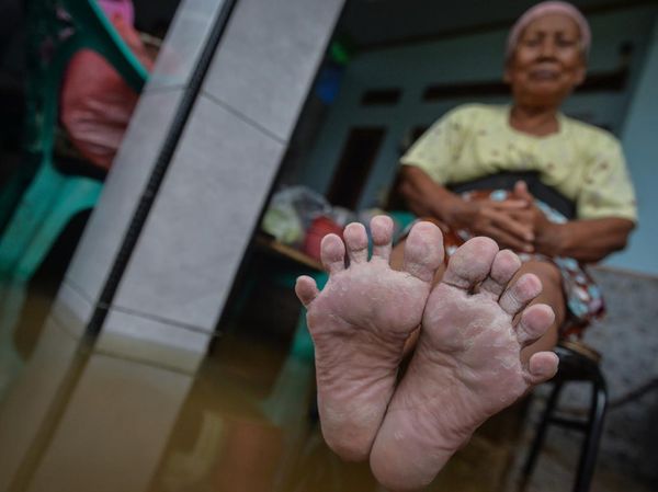 Banjir Belum Surut di Desa Pasir Ampo, Warga Mengeluh Penyakit Kulit