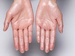 Mengapa Telapak Tangan Selalu Basah? Ini Penyebab dan Solusinya